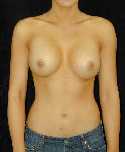 Breast Implant