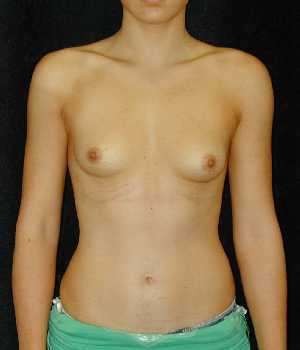 Breast Augmentation Surgery