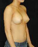 Breast Implant