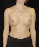 Breast Implant