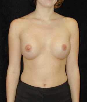 Breast Augmentation Surgery