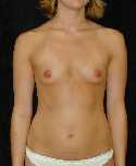 Breast Implant