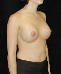 Breast Implant