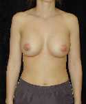 Breast Implant