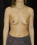 Breast Implant