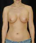 Breast Implant