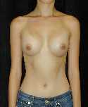 Breast Implant