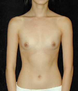 Breast Augmentation Surgery