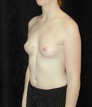 Breast Augmentation Surgery