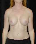 Breast Implant