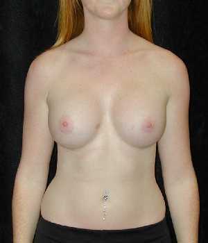 Breast Augmentation Surgery