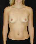 Breast Implant