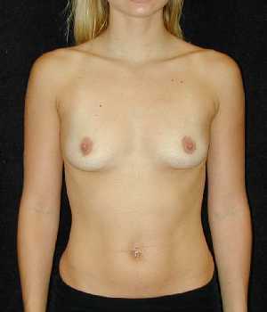 Breast Augmentation Surgery