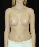 Breast Implant