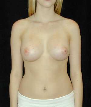 Breast Augmentation Surgery