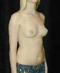 Breast Implant