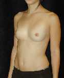 Breast Implant