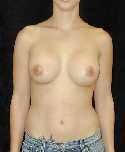 Breast Implant