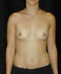 Breast Implant