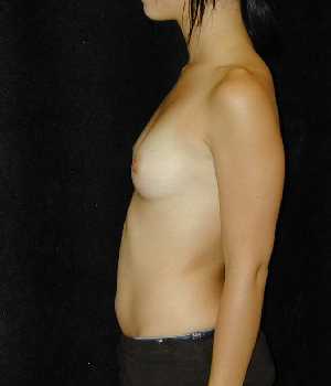 Breast Augmentation Surgery