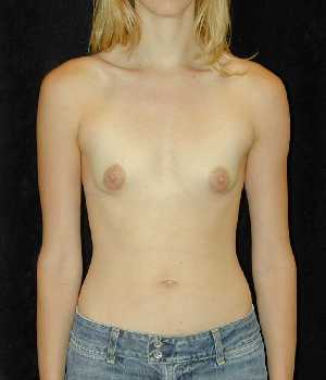 Breast Augmentation Surgery