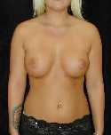 Breast Implant