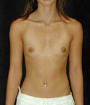 Breast Augmentation Surgery