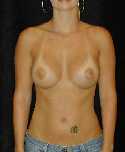 Breast Implant