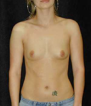 Breast Augmentation Surgery