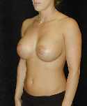 Breast Implant