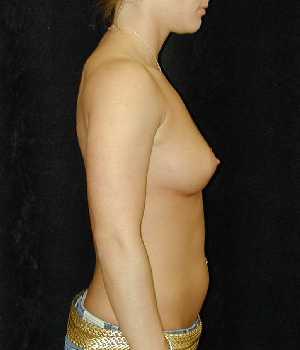 Breast Augmentation Surgery