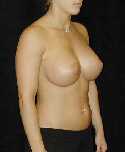 Breast Implant