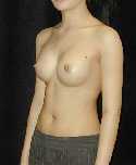 Breast Implant