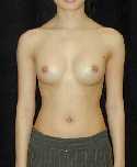 Breast Implant