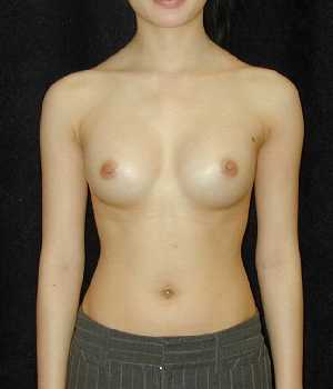 Breast Augmentation Surgery