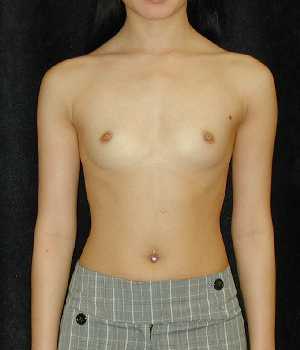 Breast Augmentation Surgery