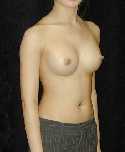 Breast Implant