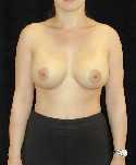 Breast Implant
