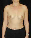 Breast Implant