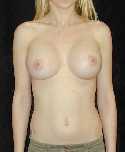 Breast Implant