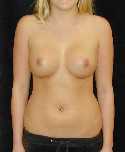 Breast Implant