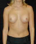 Breast Implant