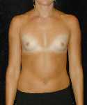 Breast Implant