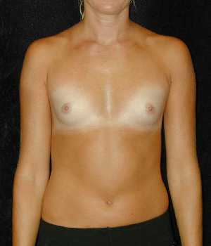 Breast Augmentation Surgery