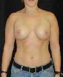 Breast Implant