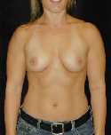 Breast Implant