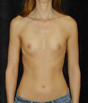 Breast Augmentation Surgery