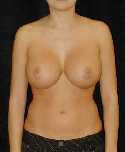 Breast Implant