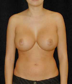 Breast Augmentation Surgery