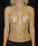 Breast Implant